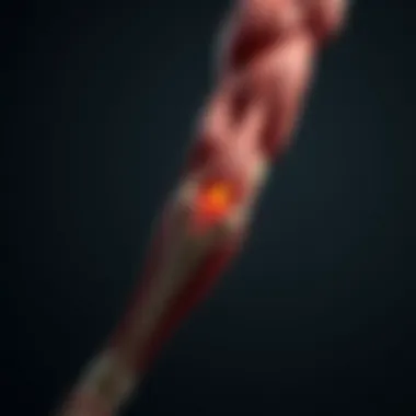 Illustration of muscle anatomy highlighting areas prone to tears