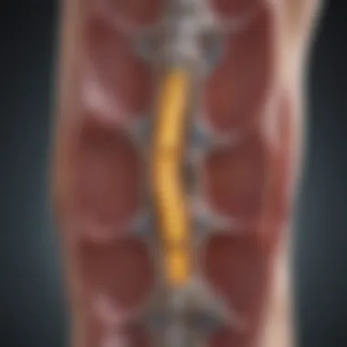 Lumbar Spine Disc Herniation Diagram illustrating multiple disc herniation in the lumbar spine